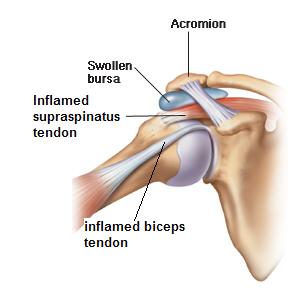 Shoulder Pain