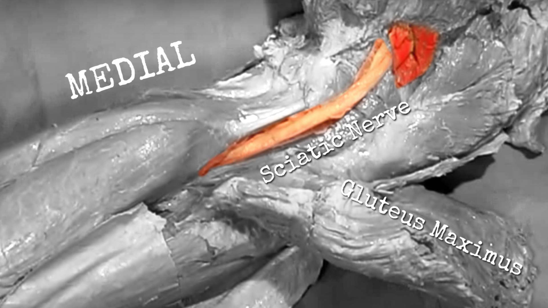 Piriformis syndrome is a neurological injury. It’s caused by the compression of your sciatic nerve by your piriformis muscle