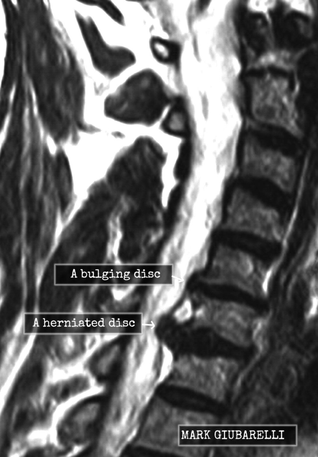 What is the difference between a bulging disc and a herniated disc?